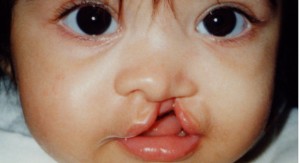 3_BlogPost_human-rights-cleft_baby